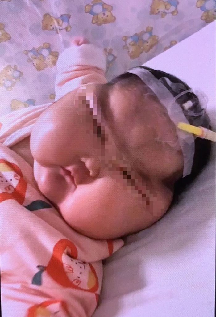 ▲在南京儿童医院就诊时，柚子的眼睛已经眯成缝，需要特定的噘嘴动作才能睁开。受访者供图