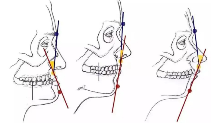 如上图所示，中间为正常人的侧颜面容，左图为凹面畸形，也就是大家所说的“地包天”，右图为突面畸形，也就是“龅牙”，这两种牙齿情况统称为“牙列不齐”，在医学上又被称为“牙颌面畸形”。