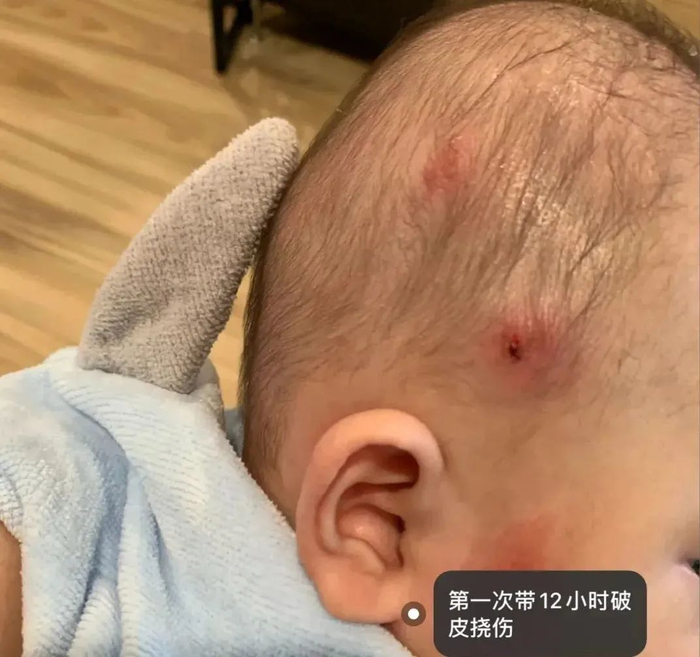▲在家长分享的孩子进行头型矫正的经验贴中，孩子初次佩戴头盔后出现红肿、破皮等现象