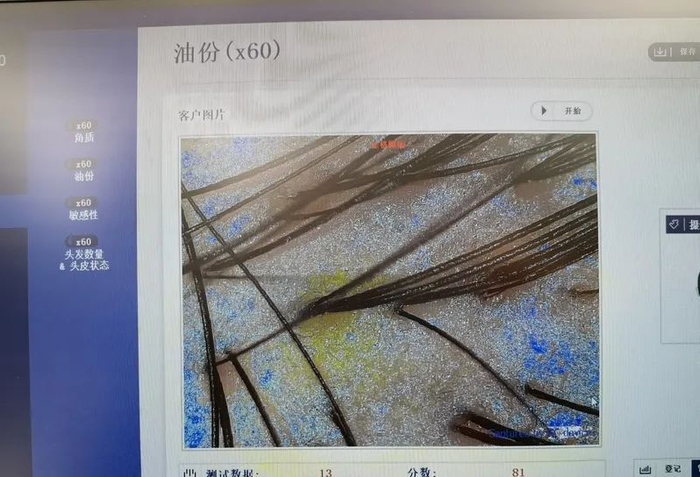 △通过头皮检测，可以了解头皮出油情况（蓝色部分为油脂）