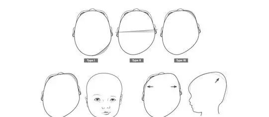 ▲斜头畸形示意图