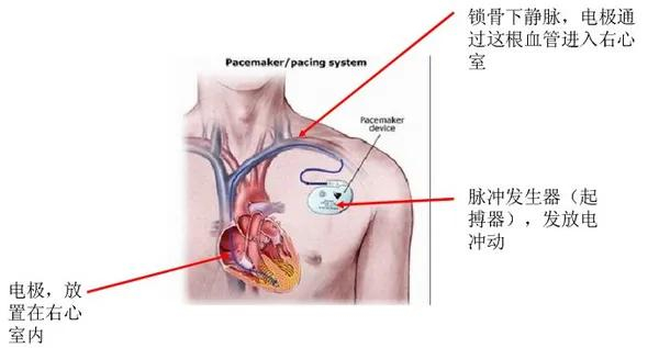 心脏起搏器作用示意图