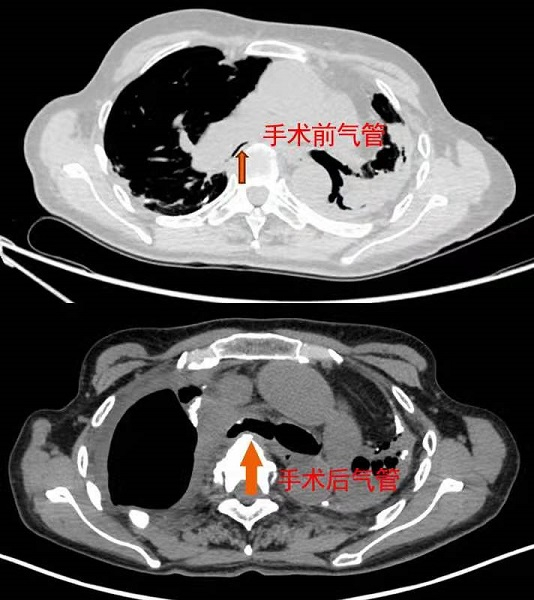 图说：术后，王阿姨重建的气管逐渐恢复了强韧