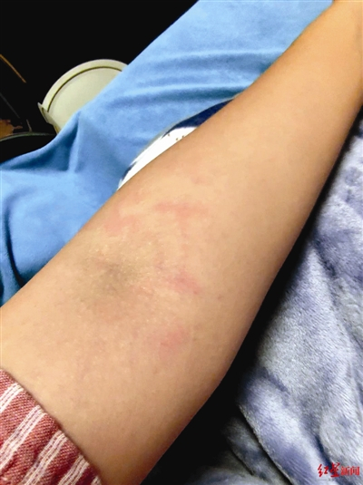 记者体验“酵素浴”，手臂被灼伤