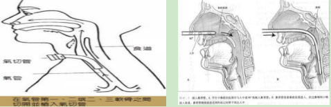 这些非典型表现，提示胃管误入气管！这样判断和处理~