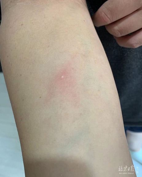 被“大象药水”喷溅后腐蚀的皮肤