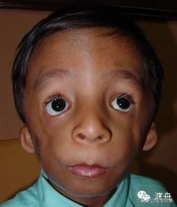 不宁腿综合征病因症状 不安腿综合征怎么治疗最好