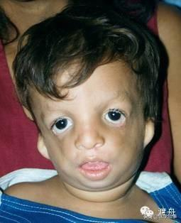 肠易激综合征为何便秘呢