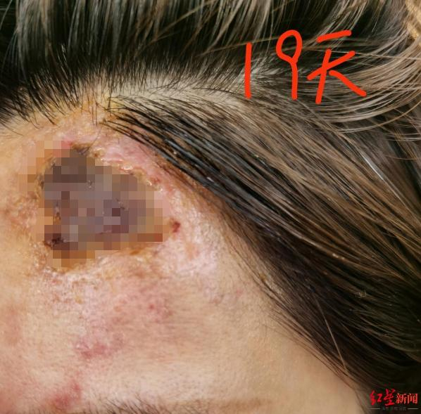 ↑依次为术后9天、12天、19天伤口状态