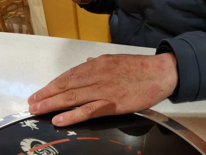 ▲吴春红手背上一片片深红的疙瘩。那是牛皮癣，同哭坏的右眼一样，都是16年监狱生活的赠品。 新京报记者 苑苏文 摄