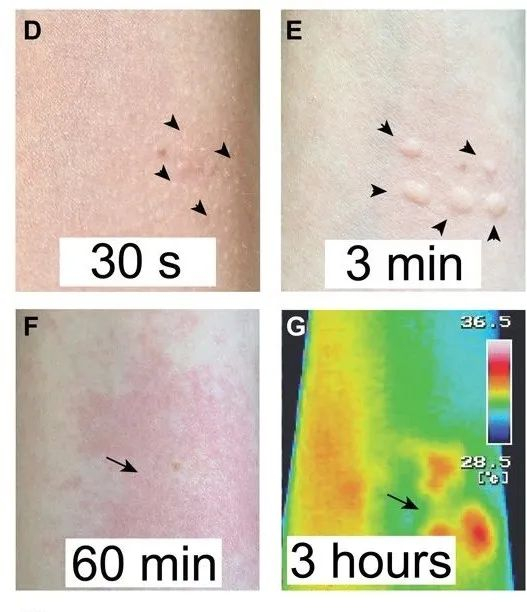 接触金皮树后皮肤随时间的反应。图片来源：（DOI）10.1126/sciadv.abb8828