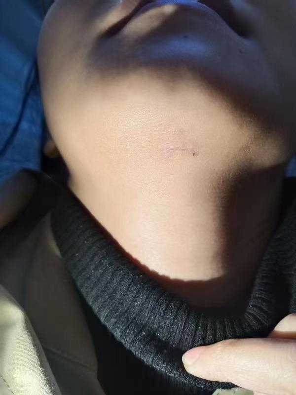 图说：术后几乎不留痕  院方供图