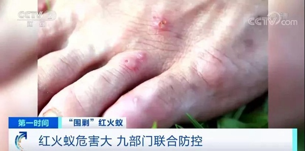 被红火蚁咬伤的皮肤（图片来源：央视财经公众号）