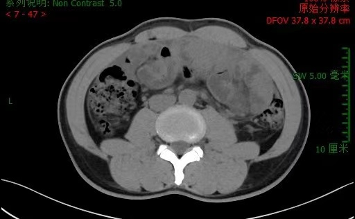 图说： 李先生入院腹部CT  采访对象供图（下同）