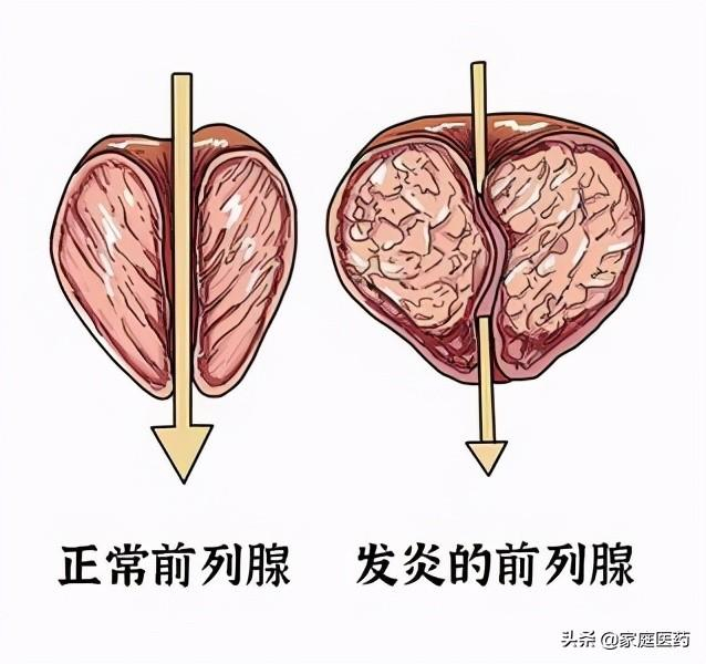 两味中药消灭慢性前列腺炎