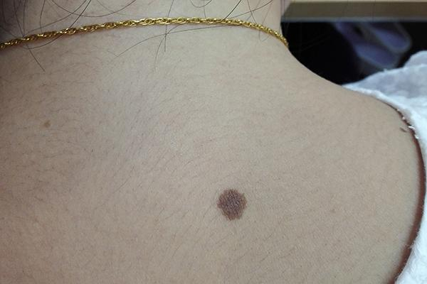 痣有好有坏,长在哪里、什么样的痣可能是坏痣?提醒:别用手抠
