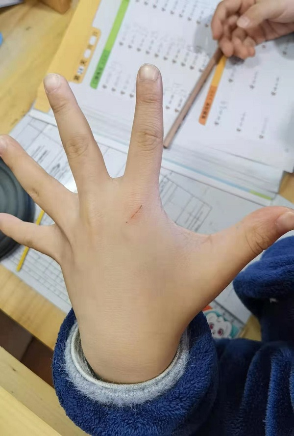 图说：许女士儿子左手背被猫抓伤