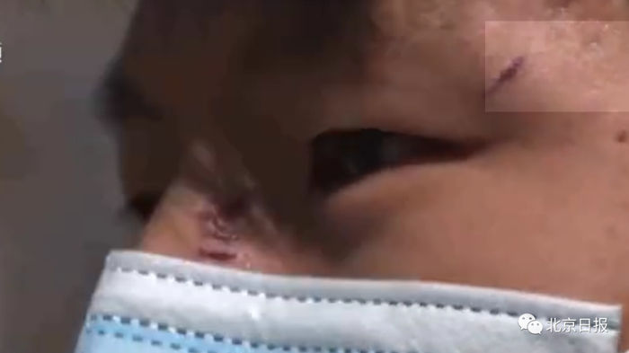 受访时，脸上仍有被打伤的痕迹