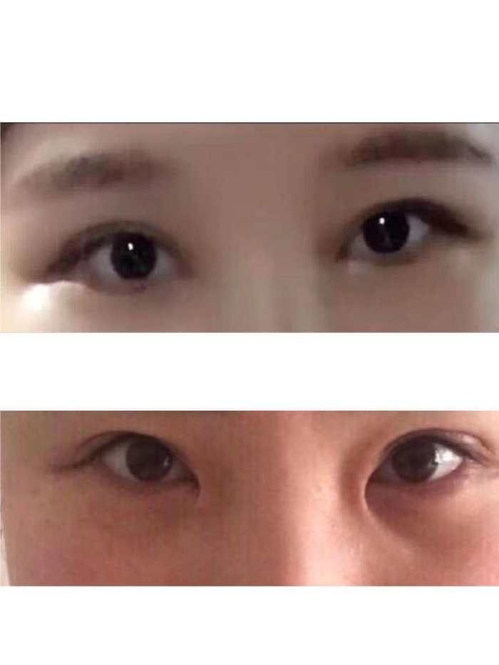  孙萌（化名）的眼部整容前后对比图，上图是整容前，下图是整容后。受访者 供图
