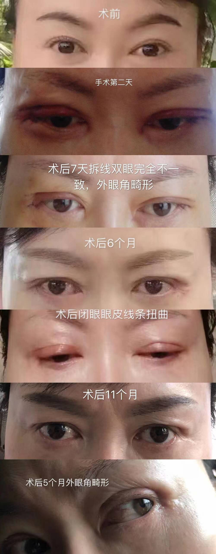  何芳（化名）的眼部整容前后对比图。受访者 供图