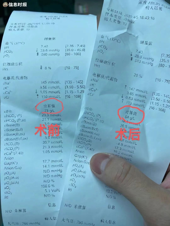 术前血红蛋白只有23克，术后恢复到84克（通讯员供图）