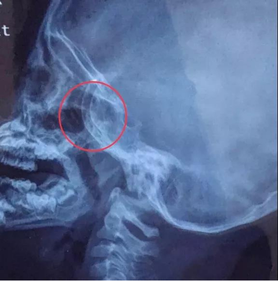 耳鼻喉内窥镜检查是检查什么腺样体肥大，你怕不怕？_https://www.jmylbn.com_新闻资讯_第3张