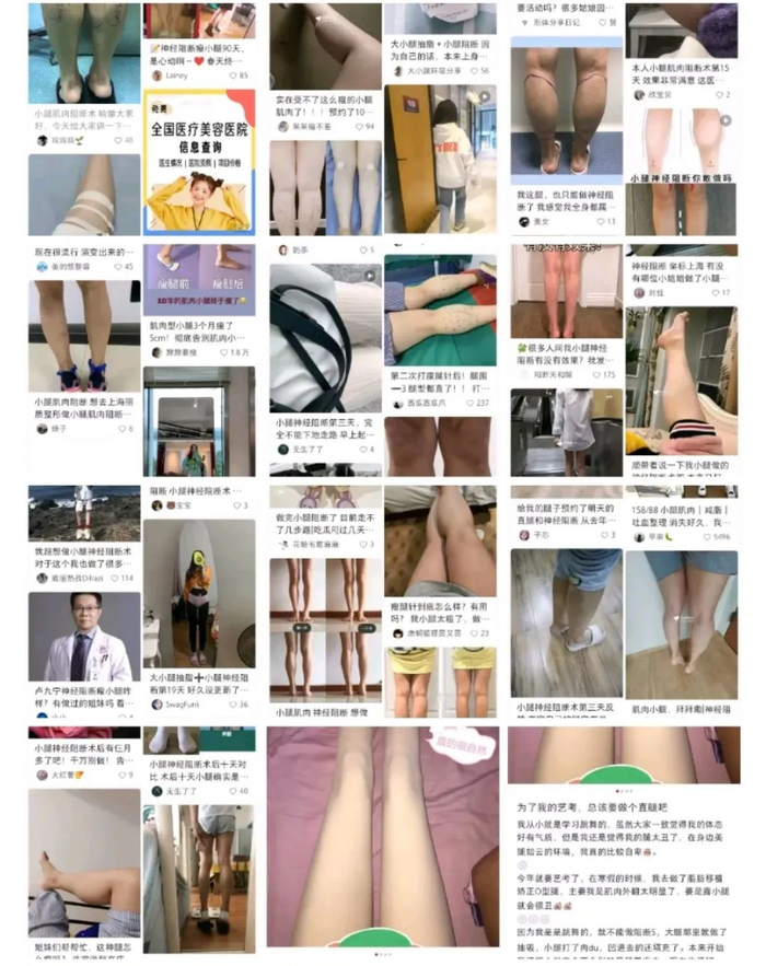 小红书平台上关于“小腿神经阻断术”的相关讨论（图片源自网络）