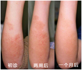 ▲治疗4次后瘙痒明显减轻，皮疹逐渐消退，色素沉着较前淡化。