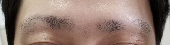 　妈妈的眉毛斑秃