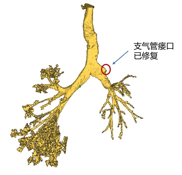 图说：右上肺支气管残端修补良好