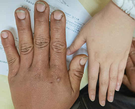 图说：患者手指末端增粗明显