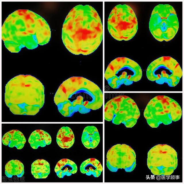 拓展PET分子影像在神经科学中的应用|PET_新浪新闻