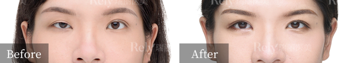 眼修复手术前后对比