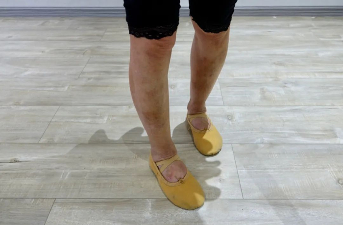 7月6日，戴大丽在舞校教室，腿和脚上痕迹满满。新京报记者 吴淋姝 摄