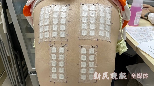 图说：患者正在进行皮肤斑贴试验