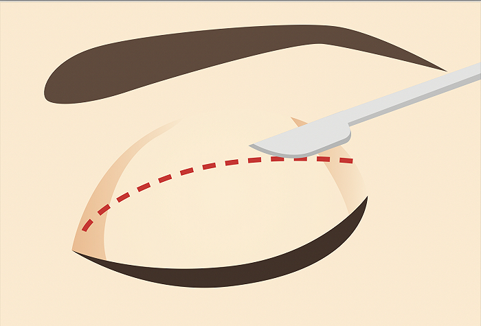 双眼皮手术示意图（来源：图虫）