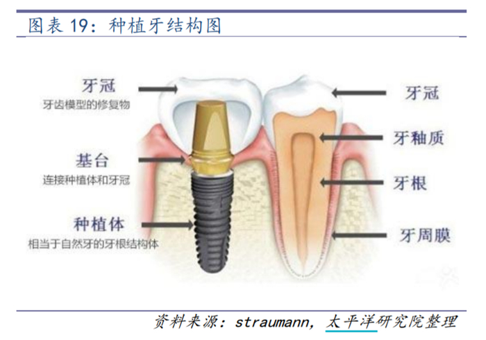 种植牙结构图 来自：太平洋证券研报