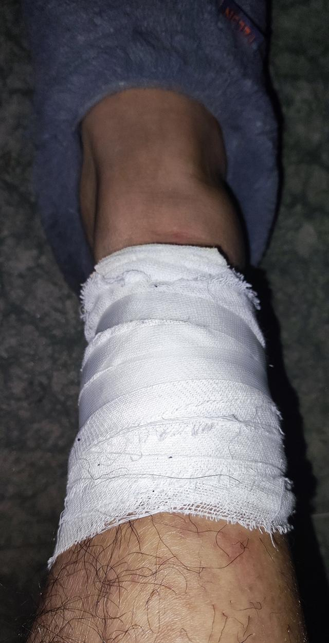 　郝先生目前的受伤情况