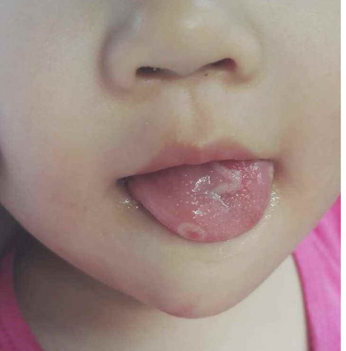 中医儿科杨晓:孩子出现地图舌是怎么回事?地图舌小儿推拿及食疗