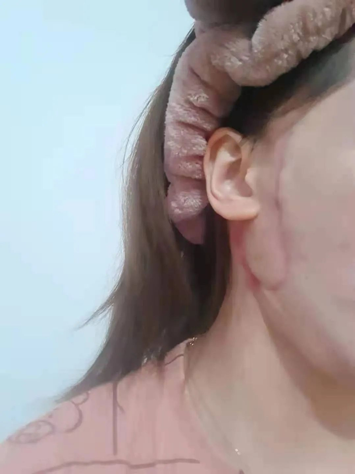 手术后，徐圆圆（化名）面部的疤痕正在逐渐恢复。受访者供图