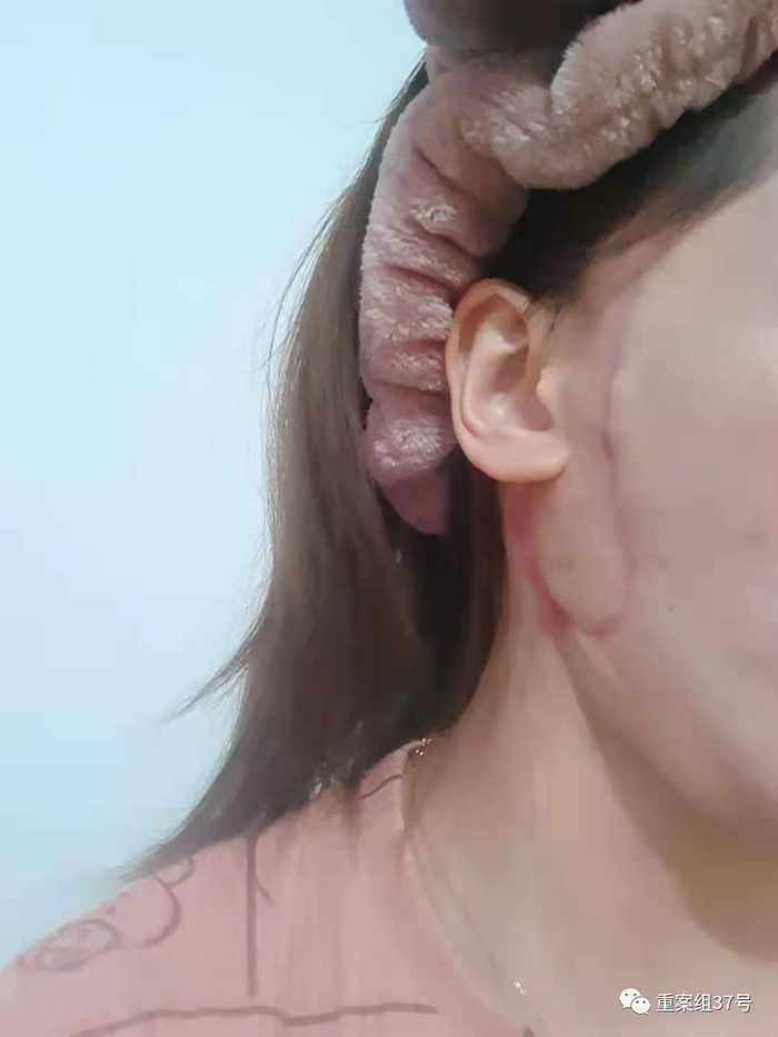 手术后，徐圆圆（化名）面部的疤痕正在逐渐恢复。受访者供图