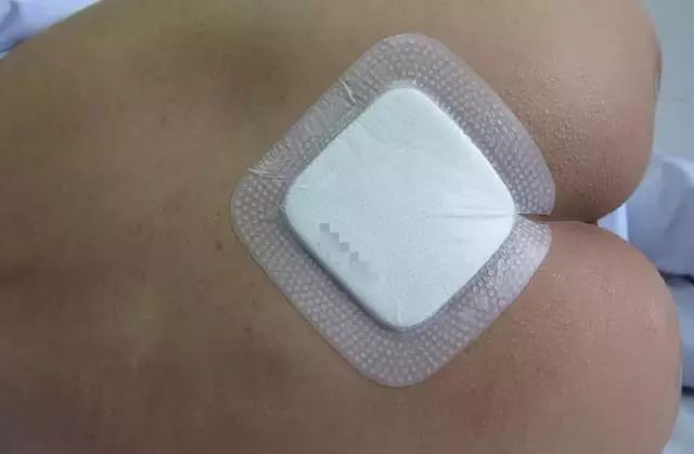 伤口贴敷料为什么ICU预防压疮敷料粘贴技巧大全,值得收藏!_新闻资讯_第16张_活检穿刺产品网 伤口贴敷料为什么ICU预防压疮敷料粘贴技巧大全,值得收藏!_https://www.jmylbn.com_新闻资讯_第16张