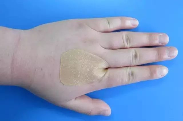 伤口贴敷料为什么ICU预防压疮敷料粘贴技巧大全,值得收藏!_新闻资讯_第12张_活检穿刺产品网 伤口贴敷料为什么ICU预防压疮敷料粘贴技巧大全,值得收藏!_https://www.jmylbn.com_新闻资讯_第12张