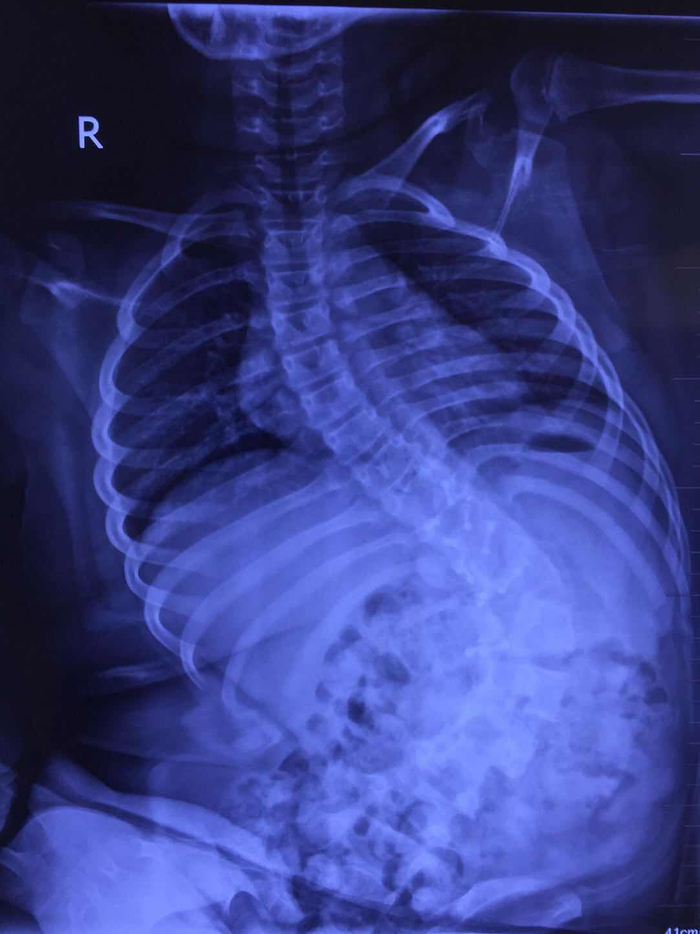 郭晓东提供的影像学资料显示，下腰瘫痪后的孩子脊柱弯成了这样。