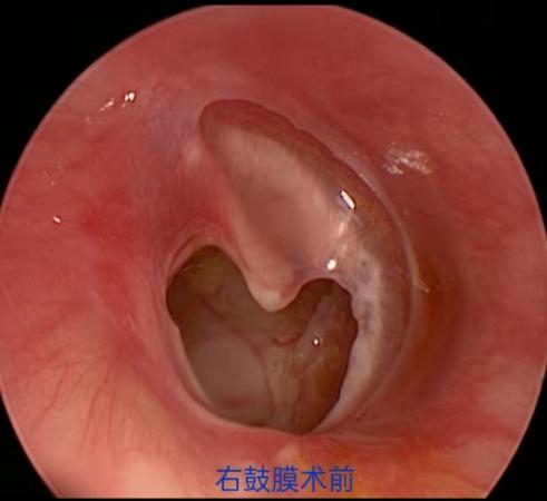 耳聋耳鸣：无声困扰背后的秘密武器