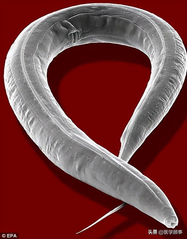 龙线虫对人体危害 四川龙线虫事件真相揭秘