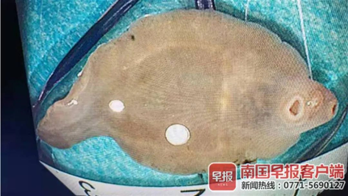 俸女士体内的寄生虫。 解放军第924医院供图