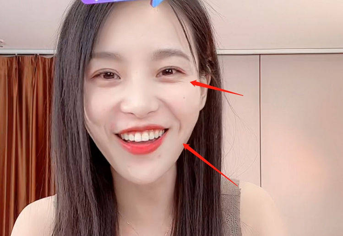 小贝饿了催吐风波后又陷入整容,打玻尿酸如今状态好疲惫