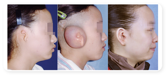 &nbsp;&nbsp;&nbsp;&nbsp;郭树忠实施外耳再造术的一个案例。&nbsp;受访者供图