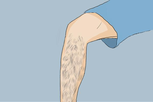 女生体毛旺盛是雄激素分泌过多？医生说：主要是这4种原因